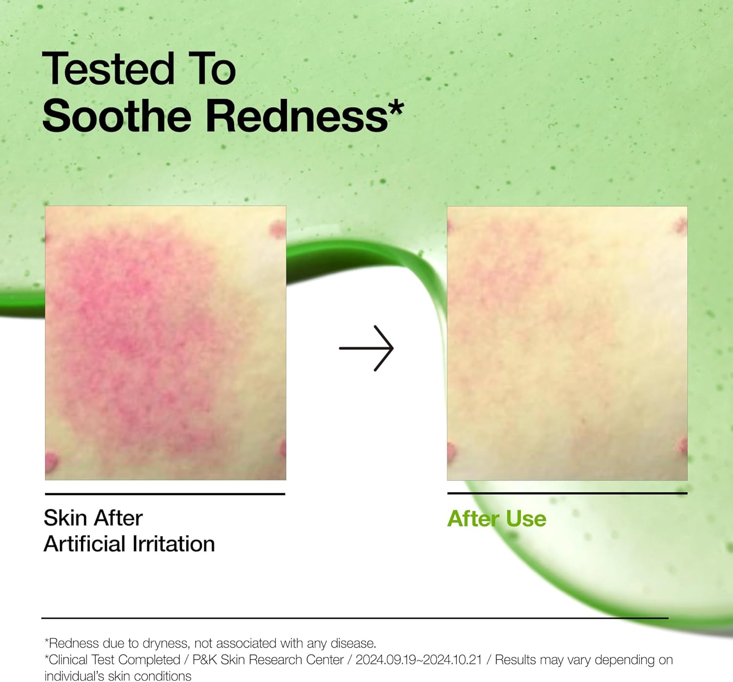 Anua Azelaic Acid 10+ Hyaluron Redness Soothing Serum, Hyaluronic Acid, 30ml/ 1.01 fl oz.