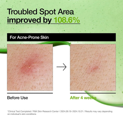 Anua Azelaic Acid 10+ Hyaluron Redness Soothing Serum, Hyaluronic Acid, 30ml/ 1.01 fl oz.